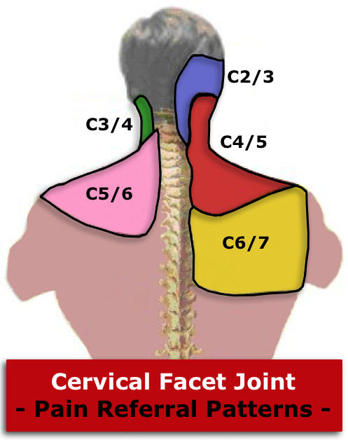 Cervical_Facet_Joint_Pain_Referral_Patterns.jpeg