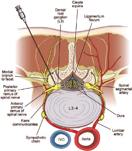 Fig-4-Axial-view-of-lumbar-transforaminal-and-selective-nerve-root-injection-The.png