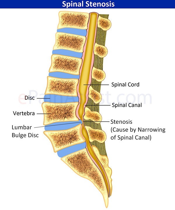 Spinal-Stenosis.jpg